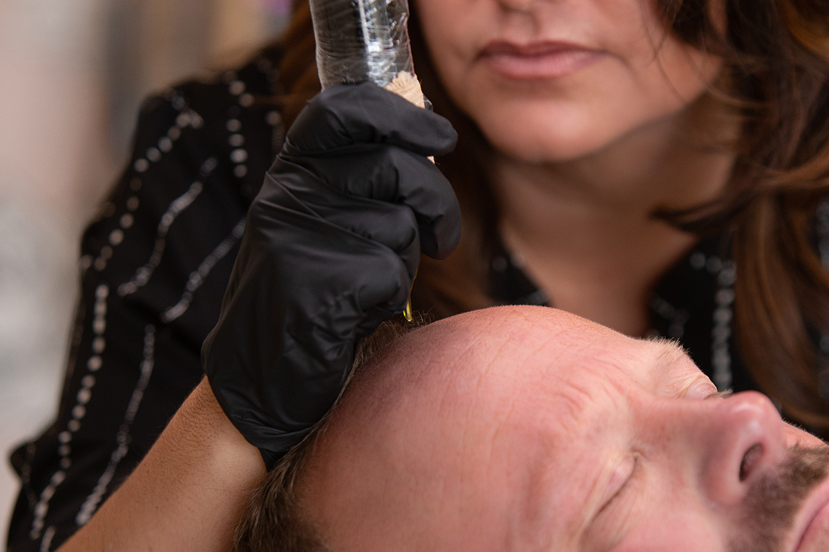 Scalp Micro Pigmentation Scalp Micro Pigmentation